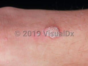 Clinical image of Common wart - imageId=885707. Click to open in gallery.  caption: 'A close-up of a verrucous plaque with overlying white scale and a similar smaller papule.'