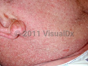 Clinical image of Acute generalized exanthematous pustulosis - imageId=888896. Click to open in gallery.  caption: 'Myriad tiny pustules and background erythema on the face, ear, and neck.'