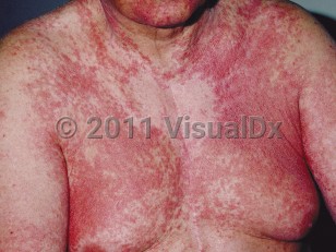 Clinical image of Autoeczematization - imageId=8915. Click to open in gallery.  caption: 'Widespread coalescing, deep red papules and plaques on the face, chest, and arms.'