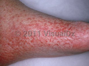 Clinical image of Leukocytoclastic vasculitis - imageId=893185. Click to open in gallery.  caption: 'Many petechiae and some purpuric patches on the foot.'
