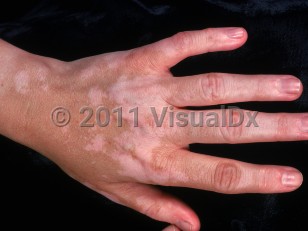 Clinical image of Vogt-Koyanagi-Harada syndrome - imageId=901376. Click to open in gallery.  caption: 'White and pale pink macules and patches (vitiligo) on the dorsal hand and fingers.'