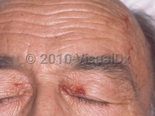 Clinical image of AL amyloidosis - imageId=91508. Click to open in gallery.  caption: 'Purpura on the medial eyelids and forehead.'