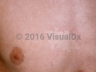 Clinical image of Nevus anemicus - imageId=93049. Click to open in gallery.  caption: 'A white patch with scalloped borders and faint surrounding erythema on the chest.'