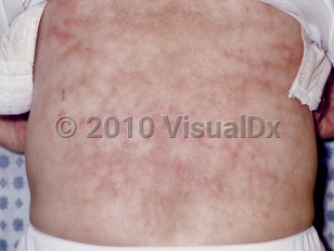 Clinical image of Erythema ab igne - imageId=93362. Click to open in gallery.  caption: 'Widespread mottled and reticulate erythema with associated light brown patches and a single crust on the back.'