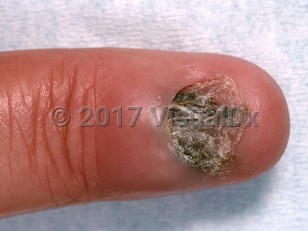Clinical image of Chronic paronychia - imageId=950402. Click to open in gallery.  caption: 'Edematous and erythematous proximal nail fold with loss of the cuticle. Note also significant nail dystrophy and dyspigmentation (possible onychomycosis in association).'