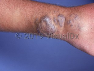 Clinical image of Cavernous hemangioma - imageId=956480. Click to open in gallery. 