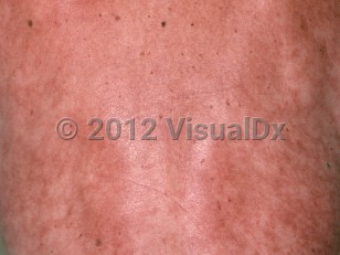 Clinical image of Angioendotheliomatosis - imageId=95671. Click to open in gallery.  caption: 'Widespread thin, reticular, reddish, and light brown plaques on the back.'