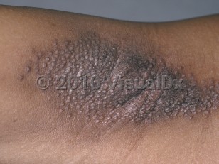 Clinical image of Fox-Fordyce disease - imageId=96390. Click to open in gallery.  caption: 'Numerous hyperpigmented, monomophic, follicular-based papules in the axilla.'
