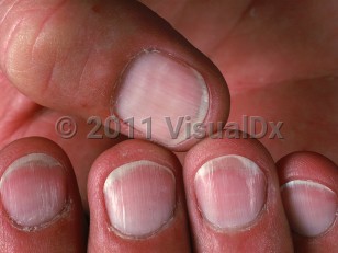 Clinical image of Liver cirrhosis - imageId=967922. Click to open in gallery.  caption: 'Fingernails with white opacity of the entire nail beds except for the distal 1- to 2-mm pink band.'